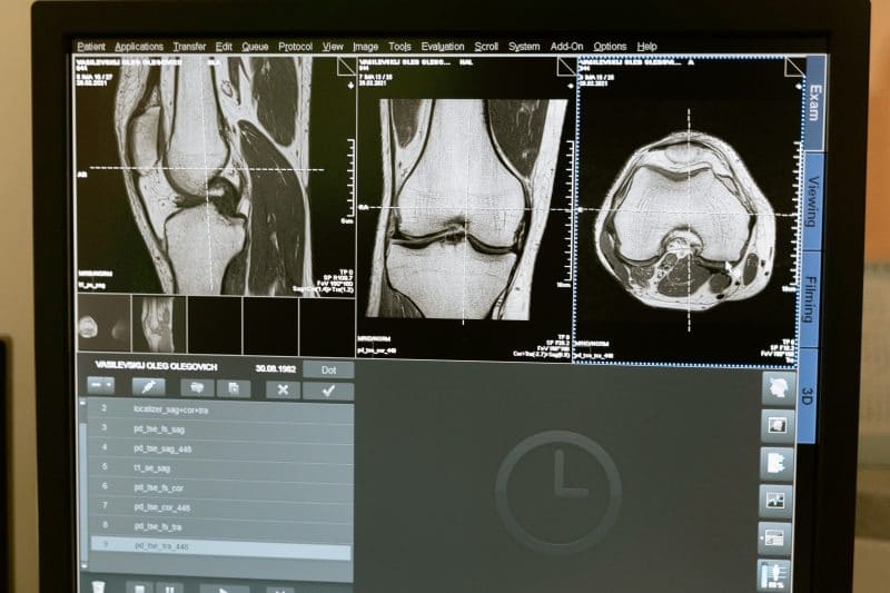 Artróza kolena prírodná liečba